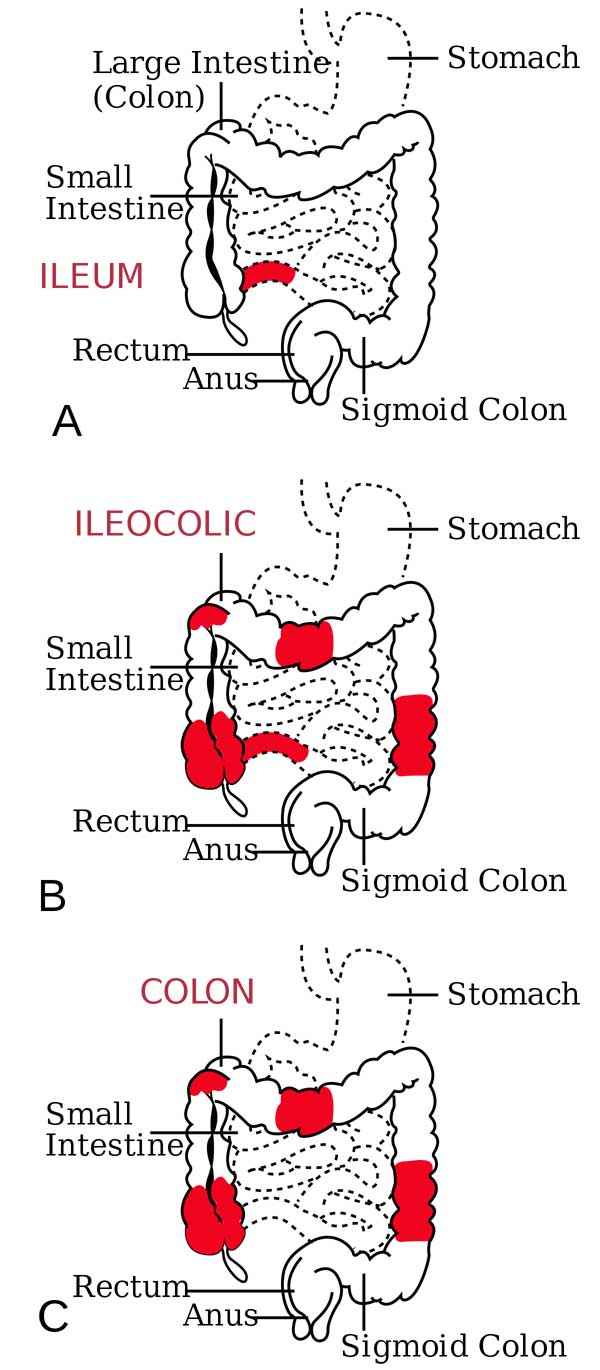 crohn